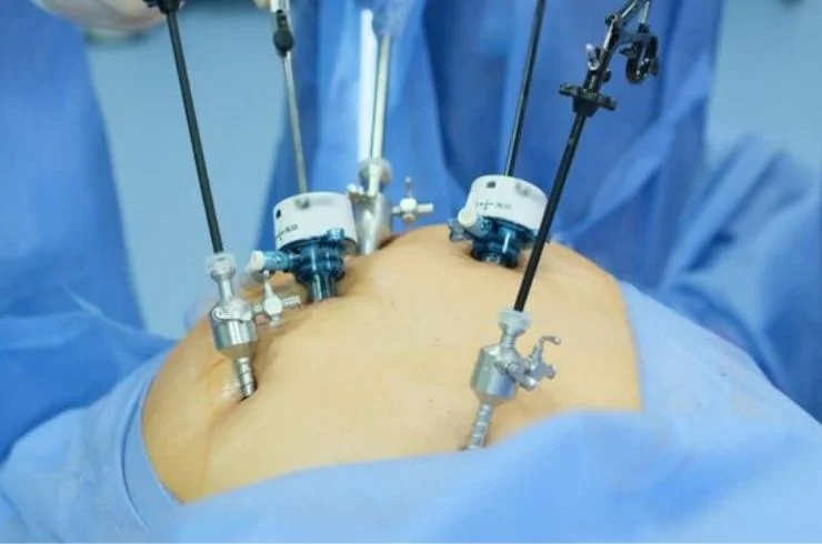 Laparoscopic Cholecystectomy